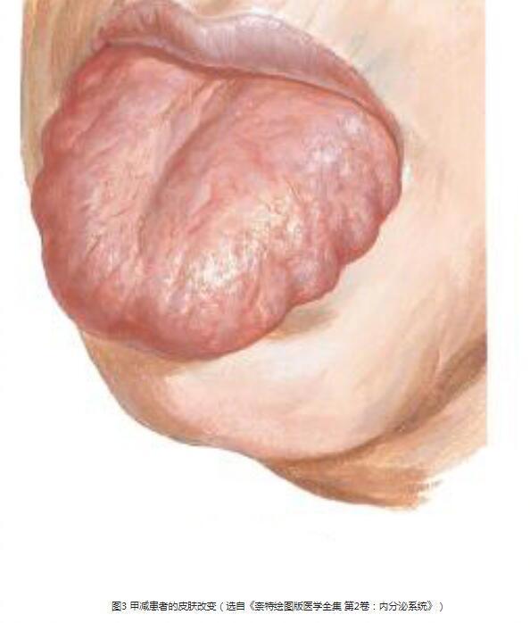 舌边有“齿痕”，查查甲状腺 - itotii